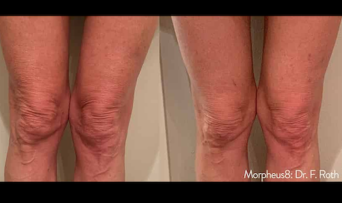 non surgical cellulite removal oakville before after